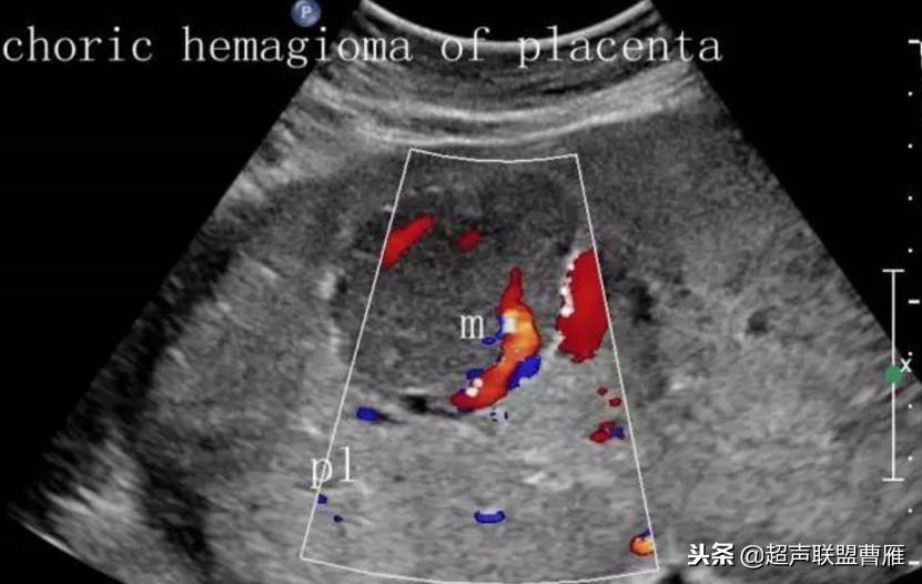 胎盘绒毛膜血管瘤是什么引起的,胎盘绒毛膜血管瘤