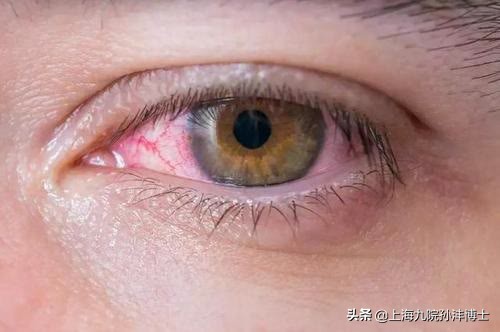 上海九院孙沣博士眼角修复,孙沣修复外眼角