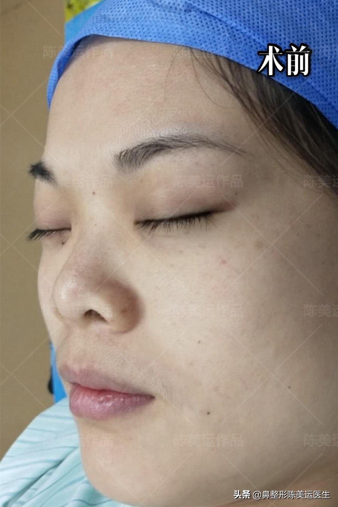 塌鼻子怎么能变成尖鼻子,鼻子太窄太小是不是很难增高鼻梁