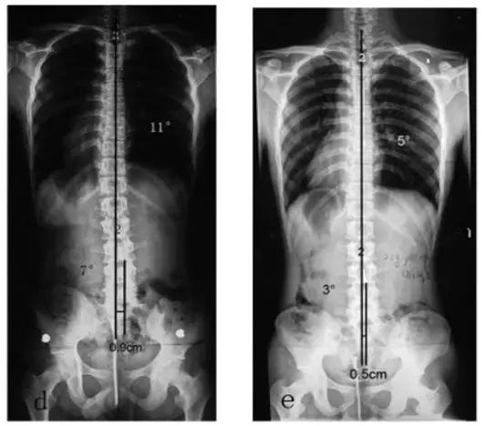 腰突脊柱侧弯最好的恢复方法,腰突为什么会引起侧弯