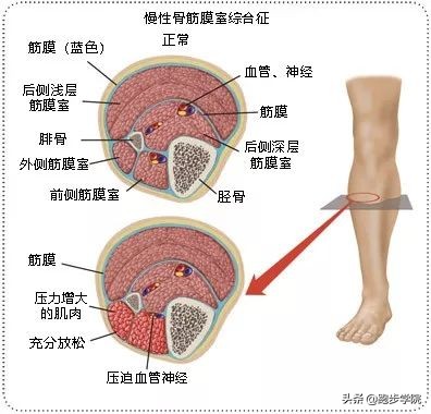 伤害了1/3跑者的胫骨炎，请务必重视起来