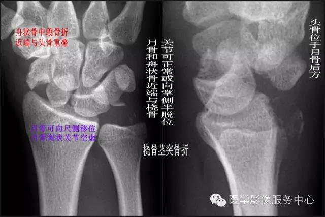 腕骨脱位x线表现,腕骨错位复位手法
