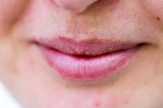 嘴唇紫里发白是什么原因,嘴唇发紫发黑应该检查什么