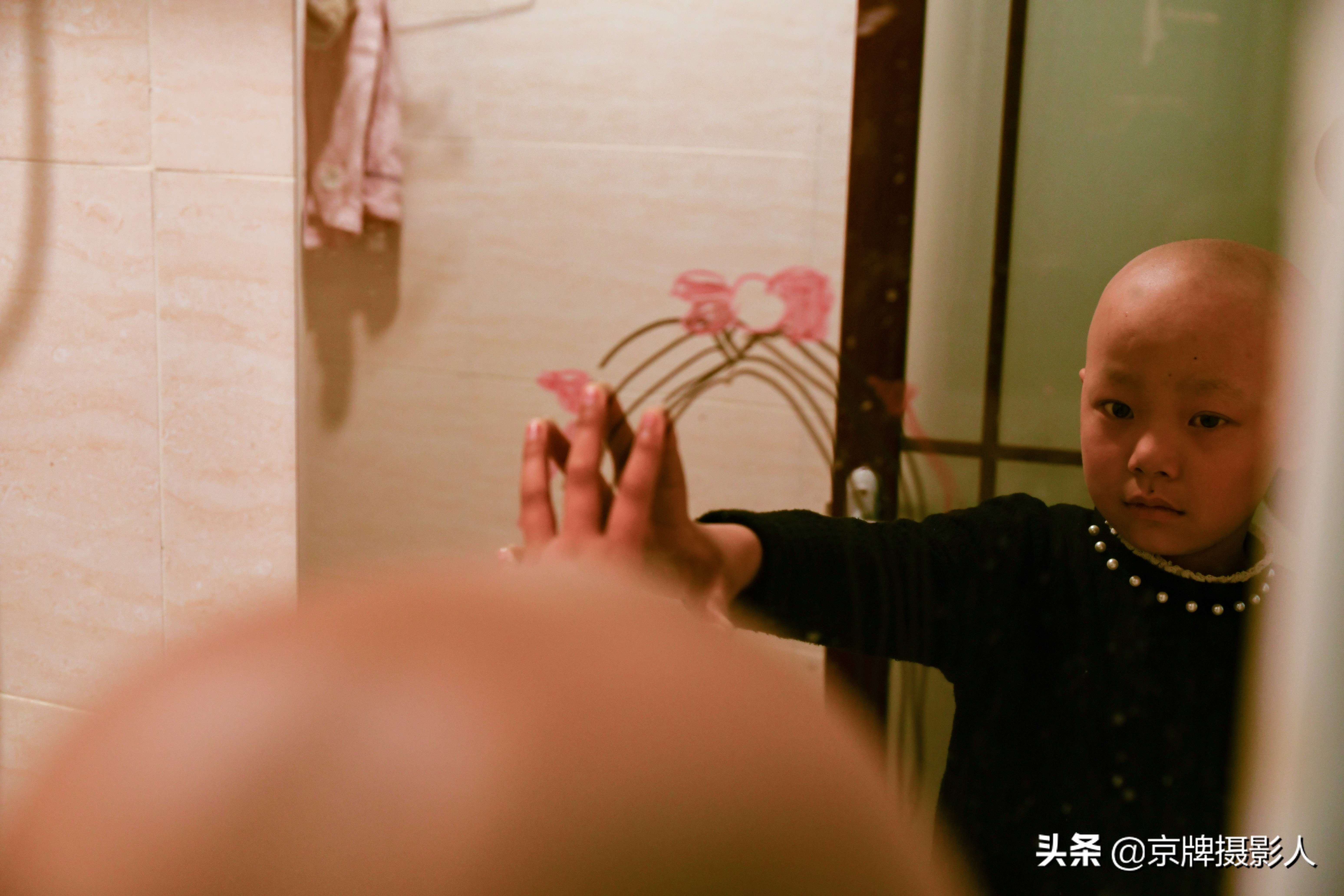 河南女孩每天戴“假发”对着镜子找自尊，3年28次化疗身心遭重创