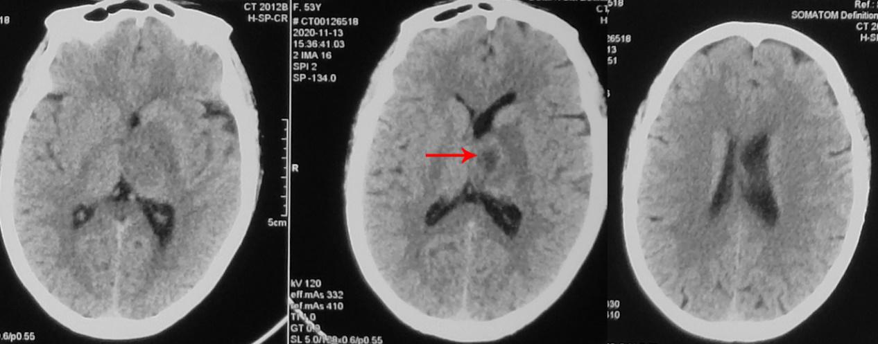 脑脓肿合并脑膜炎需要手术吗,脑脓肿进入左侧脑室严重吗