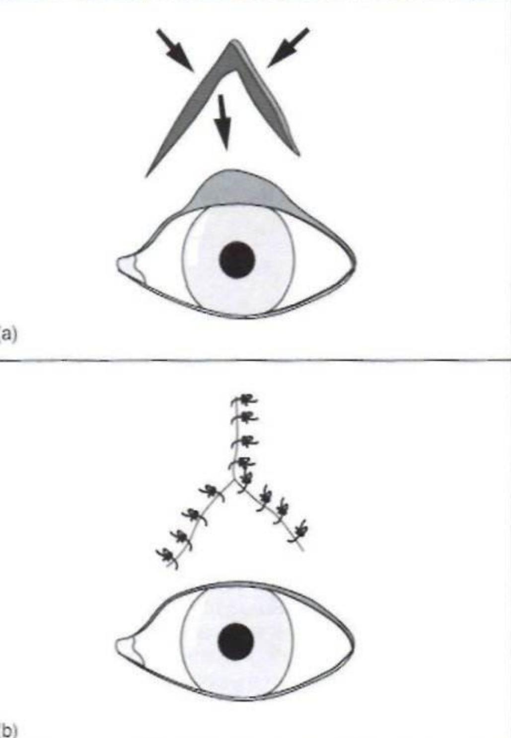 狗狗眼型怎么割双眼皮,狗狗双眼皮手术恢复