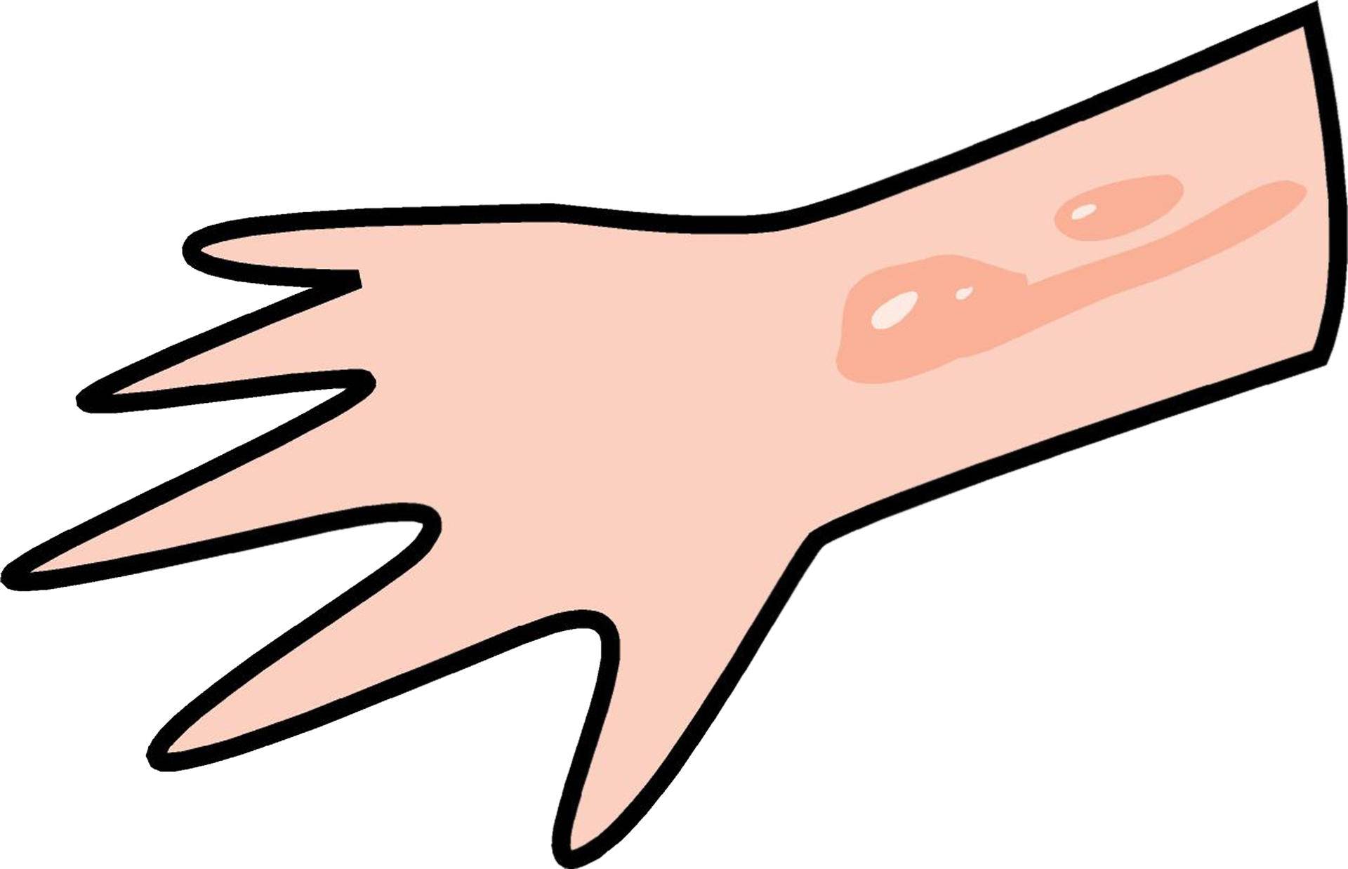 小儿烫伤没起泡怎么处理,小孩烫伤起泡怎么处理好得快