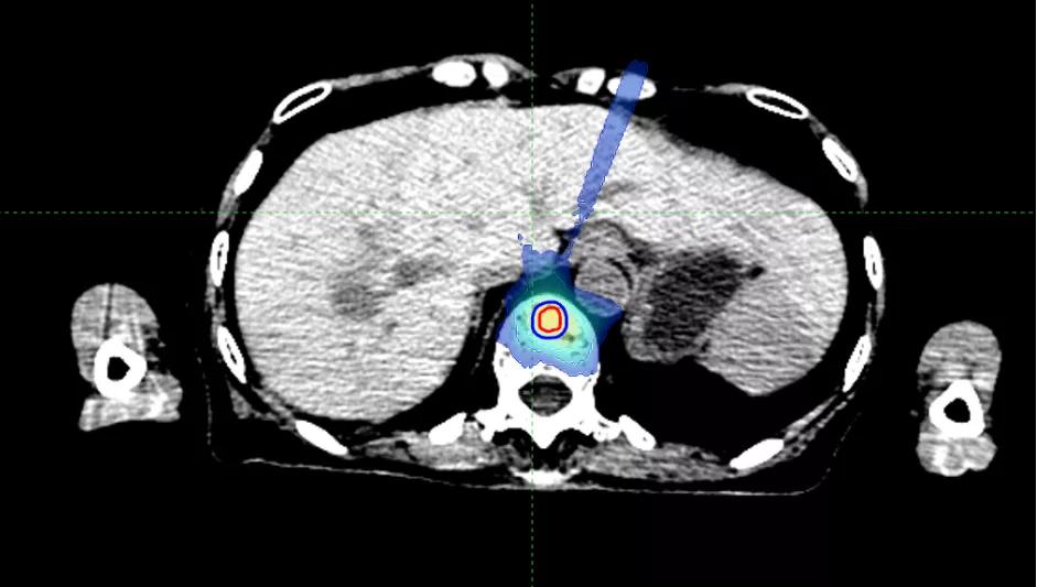 华东首秀!M6型射波刀落户国科大肿瘤医院