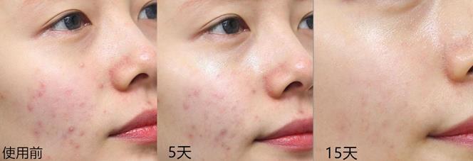 悦诗风吟小白管祛痘印效果,悦诗风吟a白瓶可以祛痘印吗