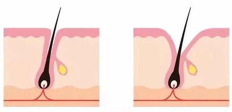 男士如何缩小脸部毛孔,脸部去黑头螨虫缩小毛孔