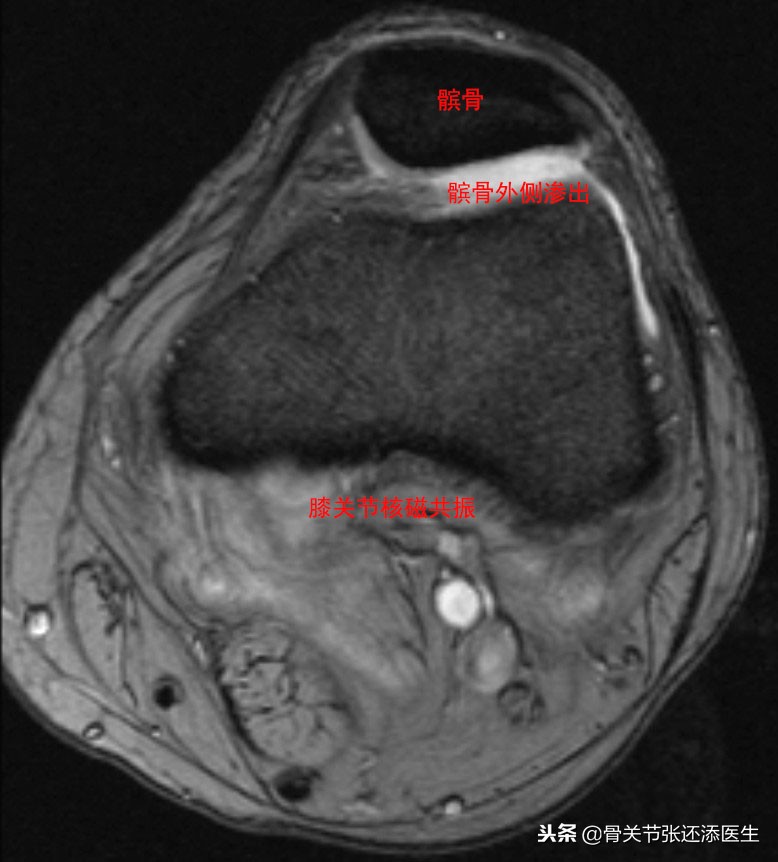 髌骨不舒服应该怎么锻炼,髌骨不肿可是疼怎么办