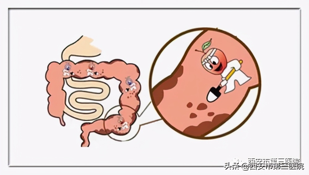 专家提醒清肠药不可以随便吃,清肠药指定时间喝不完咋办