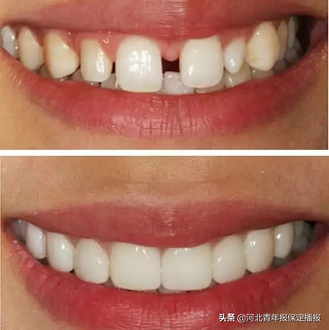 广大口腔公益种牙补贴,领取口腔优惠