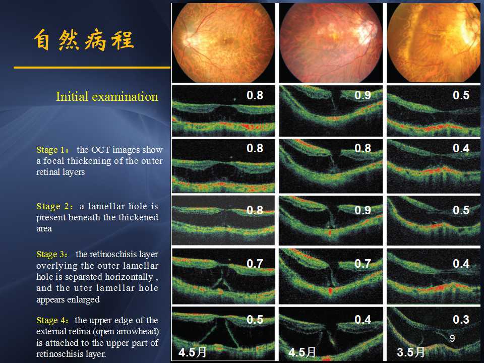高度近视黄斑劈裂哪家医院好,高度近视黄斑劈裂中医治疗