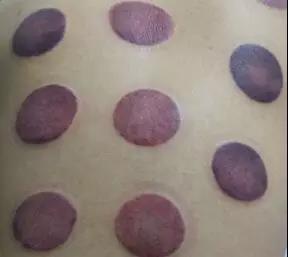 拔罐时出现罐印红是怎么回事,怎样快速消除拔罐留下的罐印