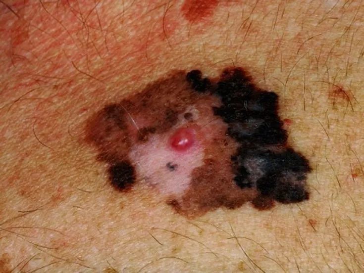 激光点痣不小心照了紫灯怎么办,切除黑色素痣可能癌变吗