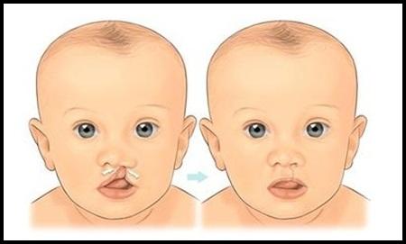 先天泌尿系统畸形能治好吗,注意缺陷多动障碍治愈