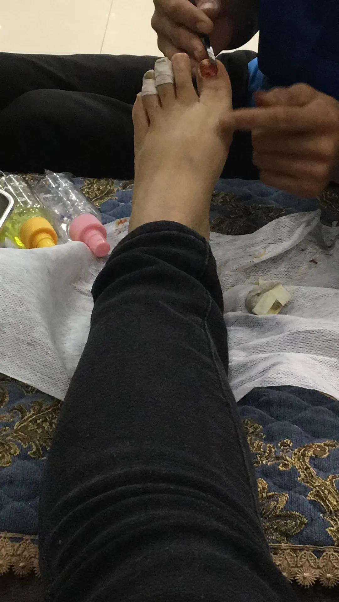 灰指甲加嵌甲治疗大概需要多少钱,灰指甲嵌甲怎么根治