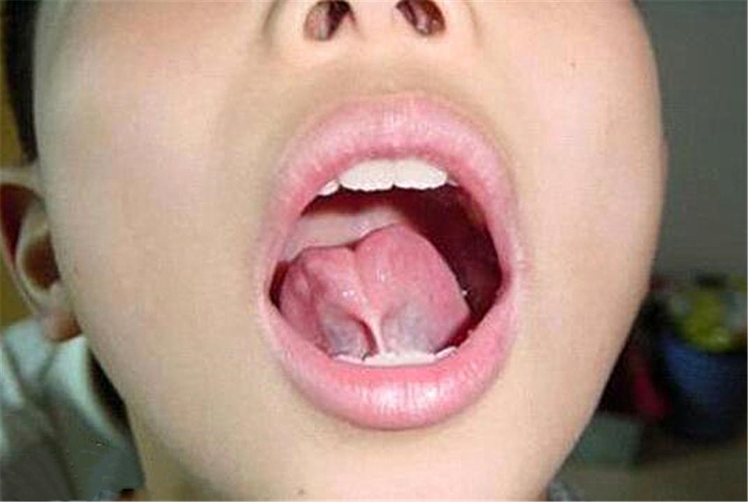 三岁孩子说话不清楚是舌系带短吗,宝宝舌系带短影响说话吗
