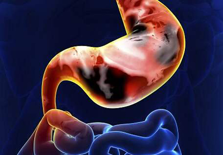 浅表性胃炎伴糜烂12指肠球炎症状,糜烂性胃炎的舌头会出现哪些症状