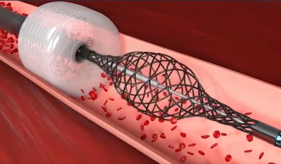 真空取栓装置，仅需3分钟，彻底解决血栓危害？药师带你看真相