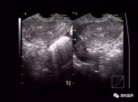 妇科阴式超声检查方法,盆底超声可检查什么疾病