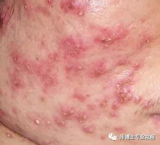 库博士祛痘痘效果怎么样,库博士专业祛痘长沙