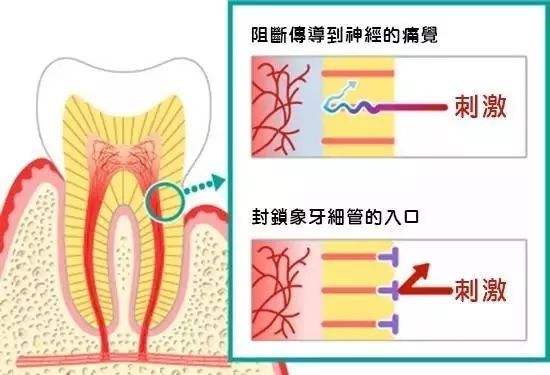 刷牙感觉牙齿松动怎么回事,由于刷牙太猛导致牙齿损伤怎么办