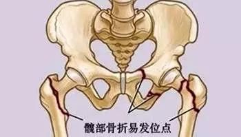 87岁老人髋关节摔骨折了怎么治疗,80岁老人胯骨摔骨折怎么恢复