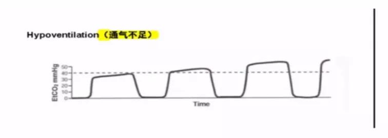 李娟教授：呼气末二氧化碳分压监测的临床应用