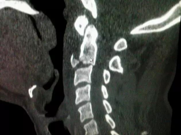 所有骨折都叫什么名字,骨折的名称有哪些