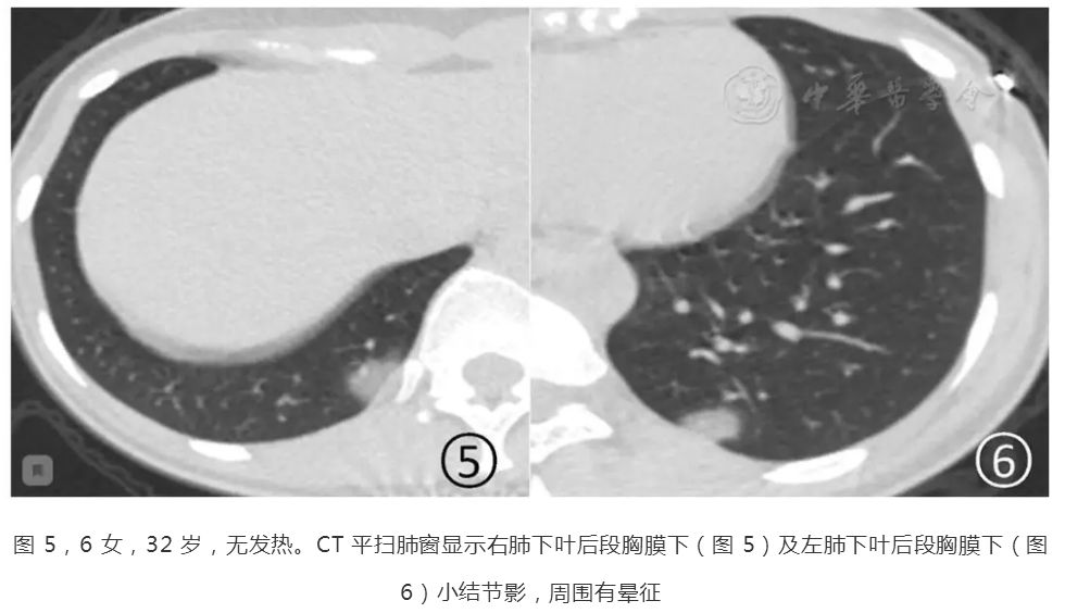 磨玻璃阴影怎么处理,磨玻璃阴影