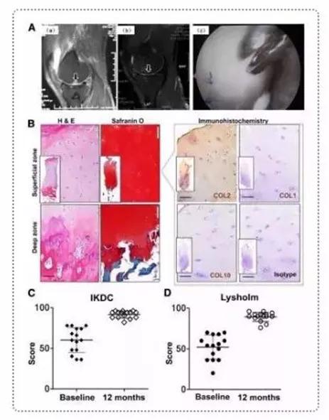 干细胞治疗膝关节软骨缺损,干细胞注射膝关节可以修复软骨吗