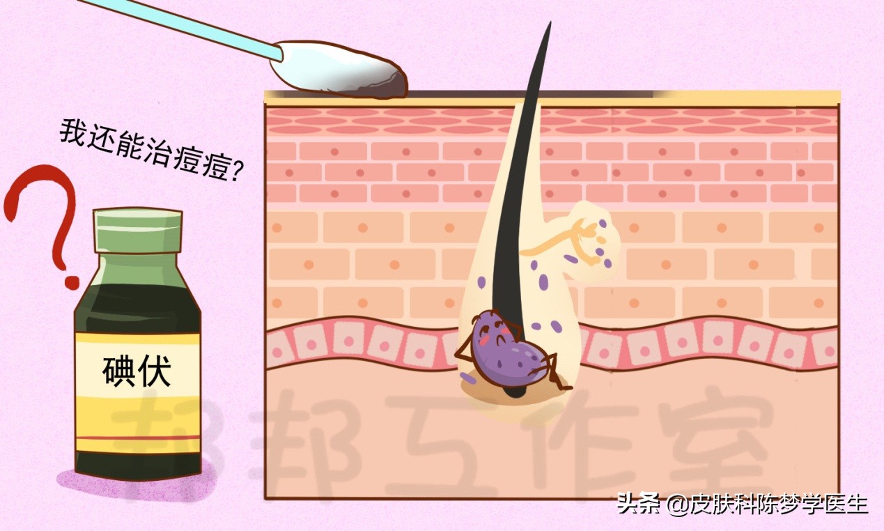 碘伏治疗痘痘,碘伏治疗痘痘好方法