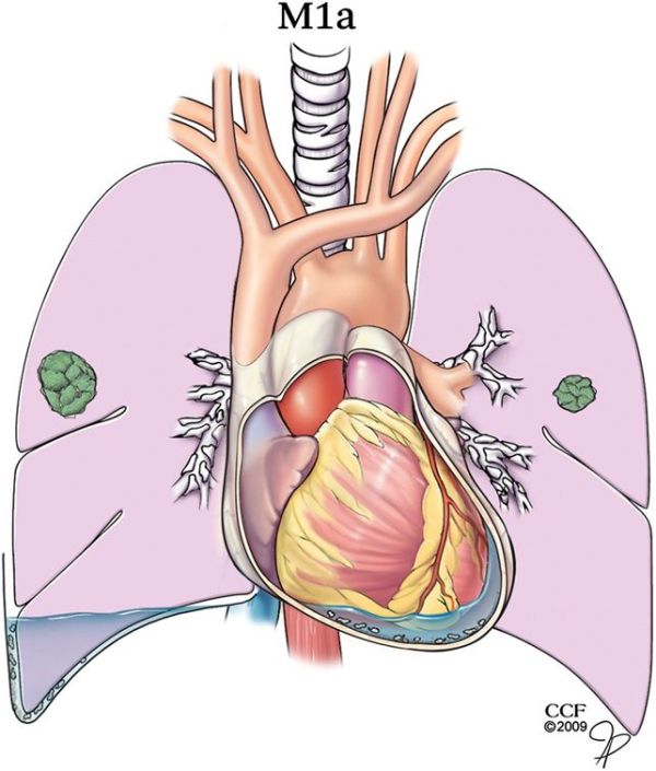 肺癌早晚期怎么分辨,肺癌如何判定早期晚期