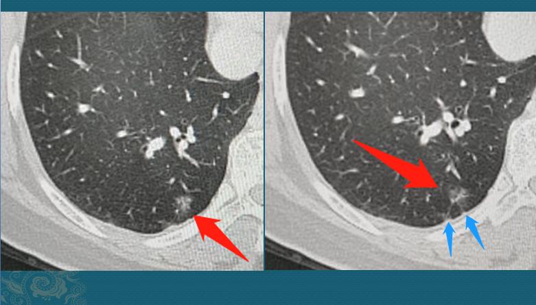 癌细胞增长的速度,癌细胞爆发性扩散