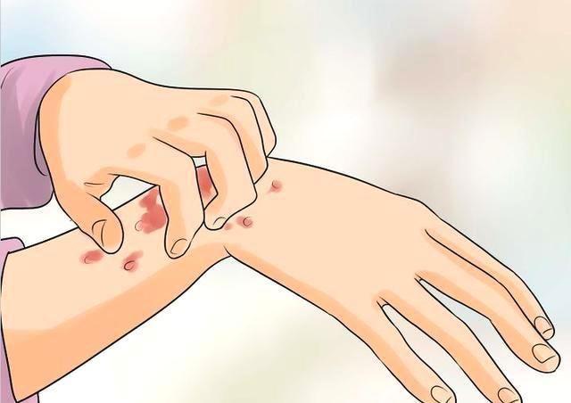 寒性荨麻疹与什么脏腑有关,夏天引起荨麻疹的主要病因