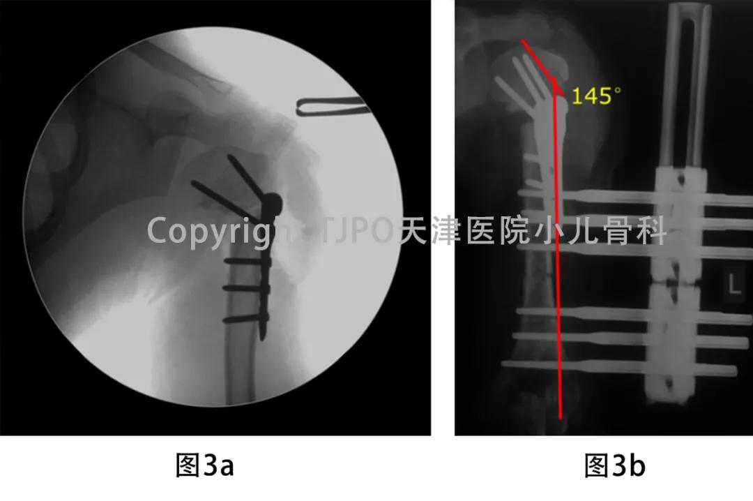 小儿骨科矫正足内翻,宝宝足内翻矫形支具