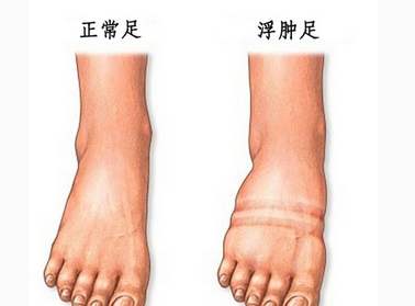 女生的腿哪样才算是最标准,女性腿粗的原因有哪些