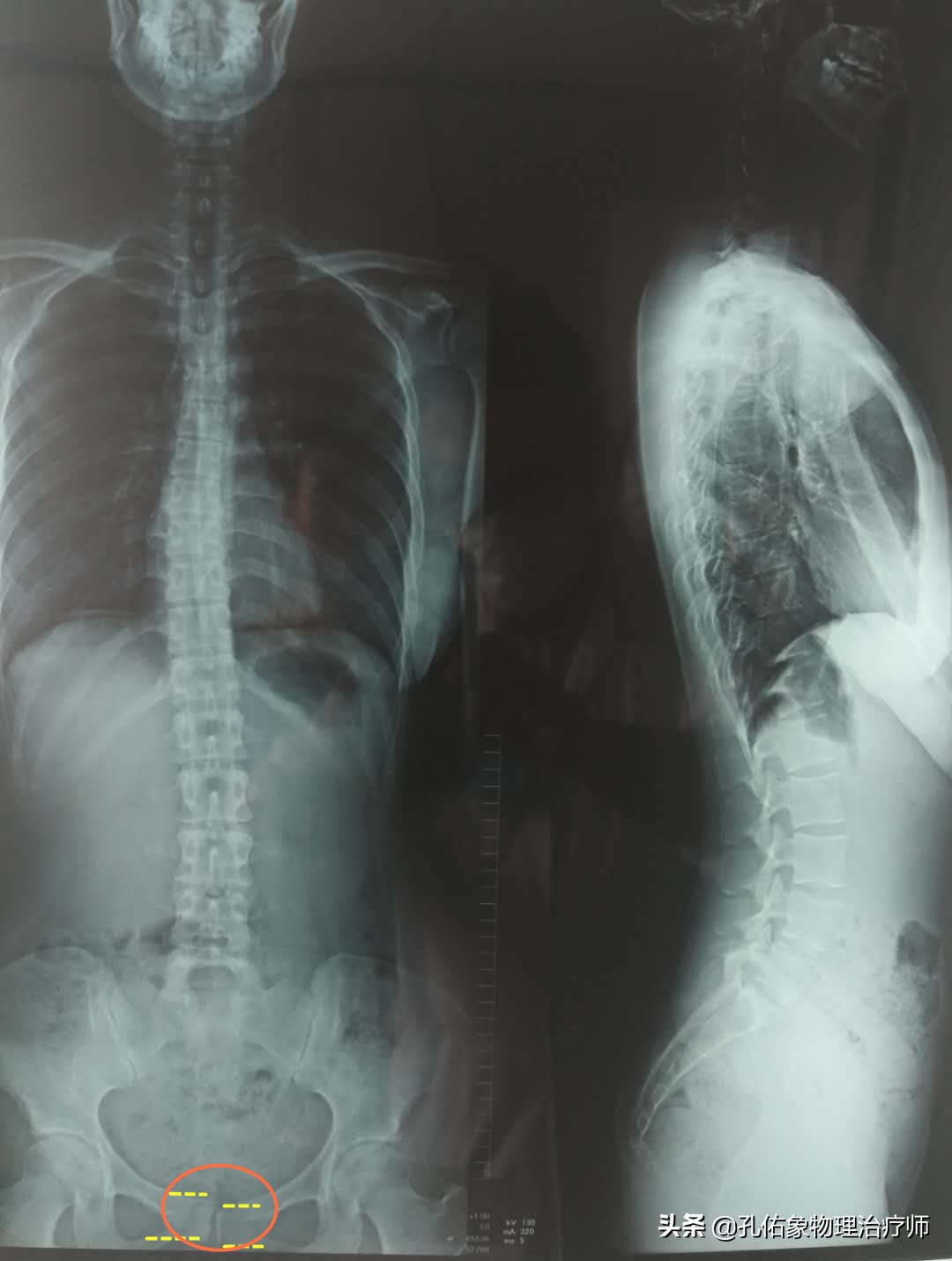 女大腿根内侧疼痛是什么原因,女性左大腿内侧根部疼是怎么回事