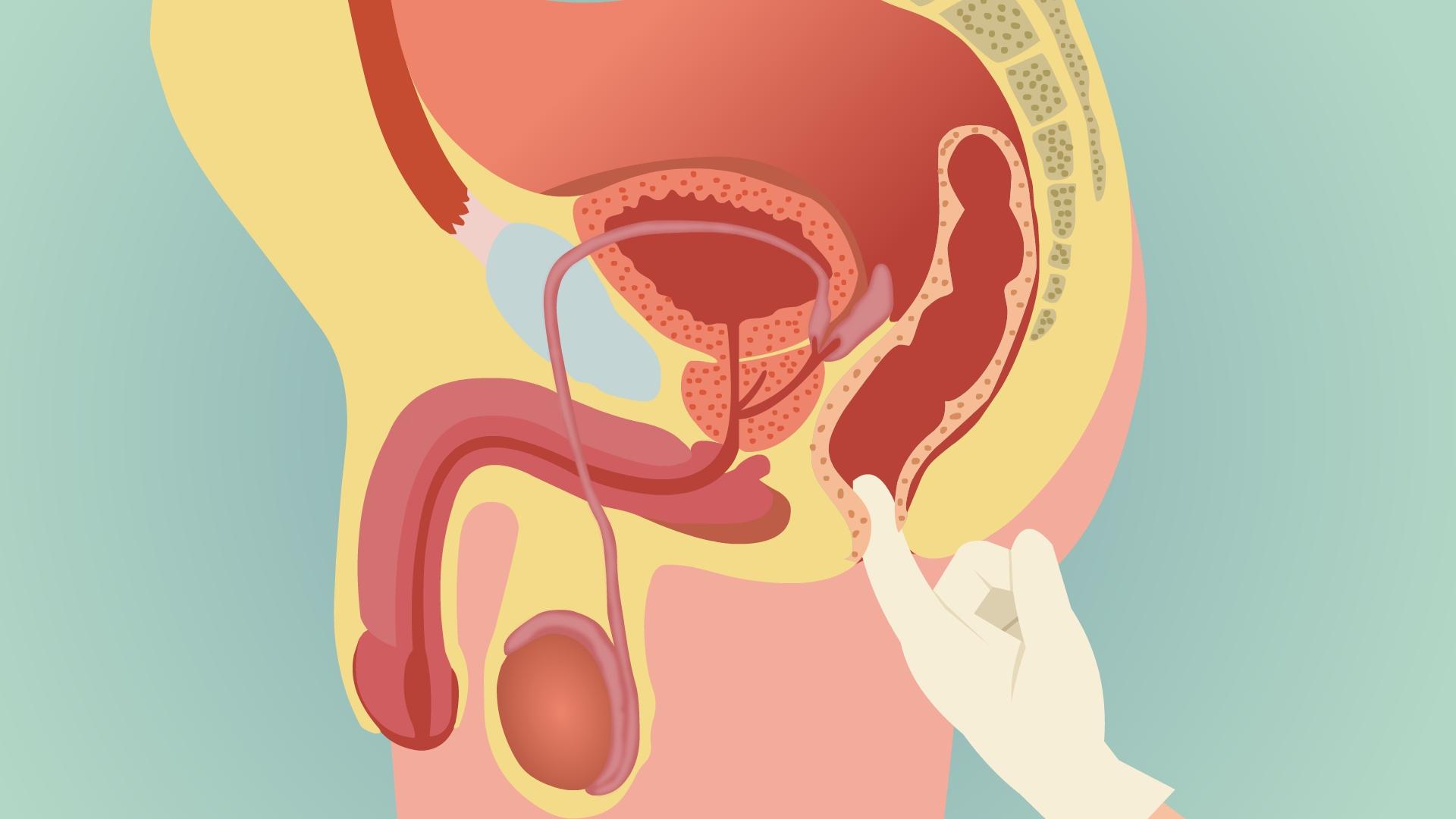 直肠内全层套叠要尽快手术吗,成人直肠套叠是肠癌吗
