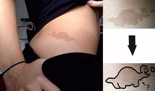 「热点资讯」臀部长胎记似恐龙，这个英国小妹火了