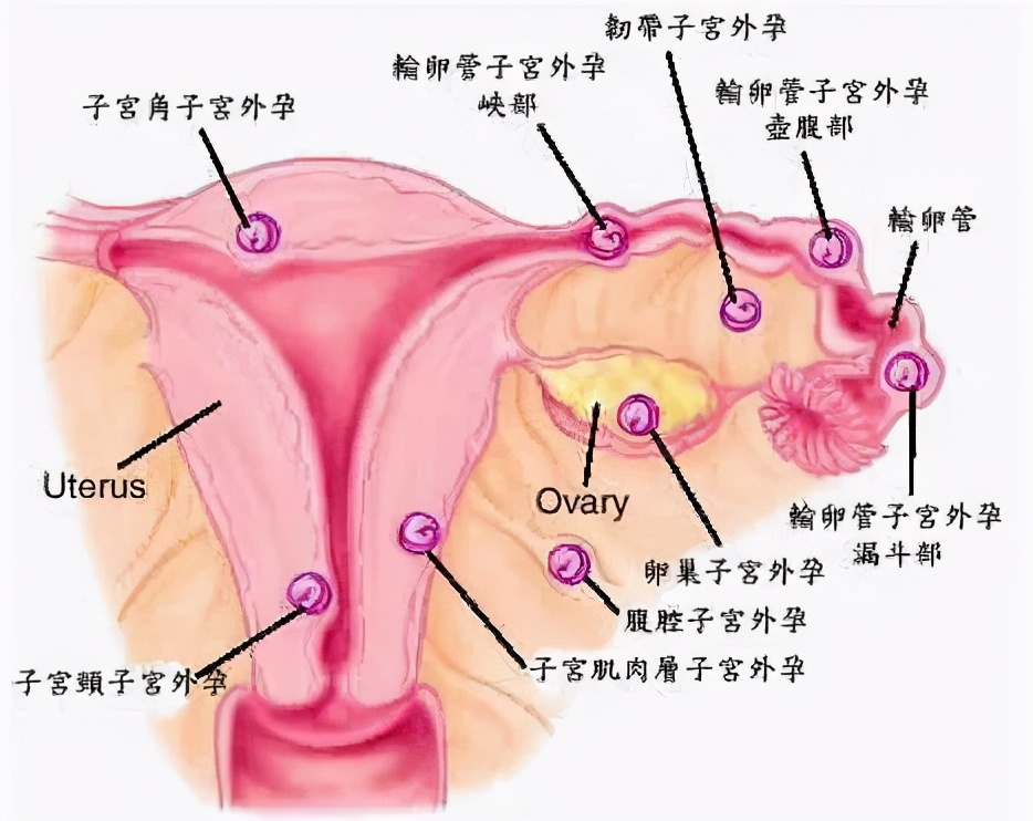 对“死神”说:放开那女孩!——妇科成功抢救异位妊娠患者