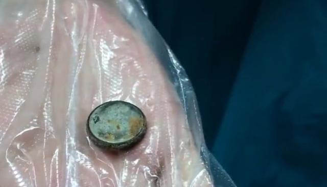 孩子误食纽扣电池多长时间能排出,孩子误吞纽扣电池怎么办