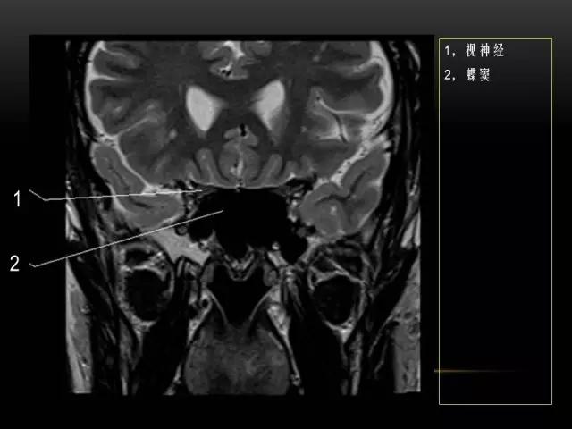 鼻腔鼻窦及颅底ct影像解剖,鼻窦解剖mri