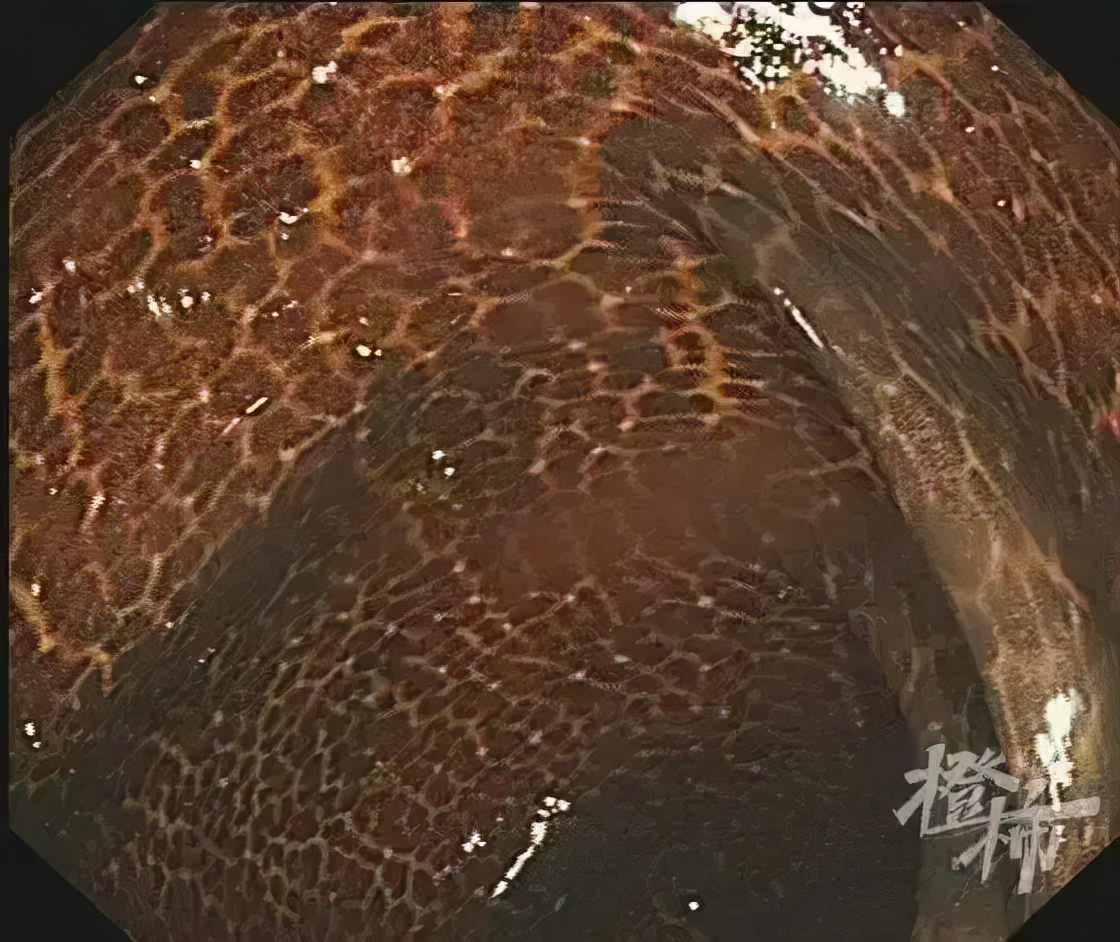 喝酵素肠子变成蛇皮的阿姨后续,阿姨吃三年酵素肠子像蛇皮