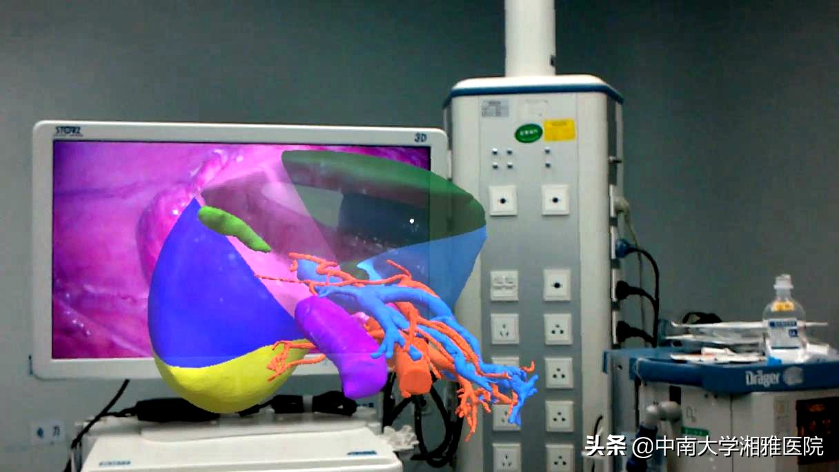 湘雅医院肿瘤微创介入,湖南湘雅治疗肝癌晚期