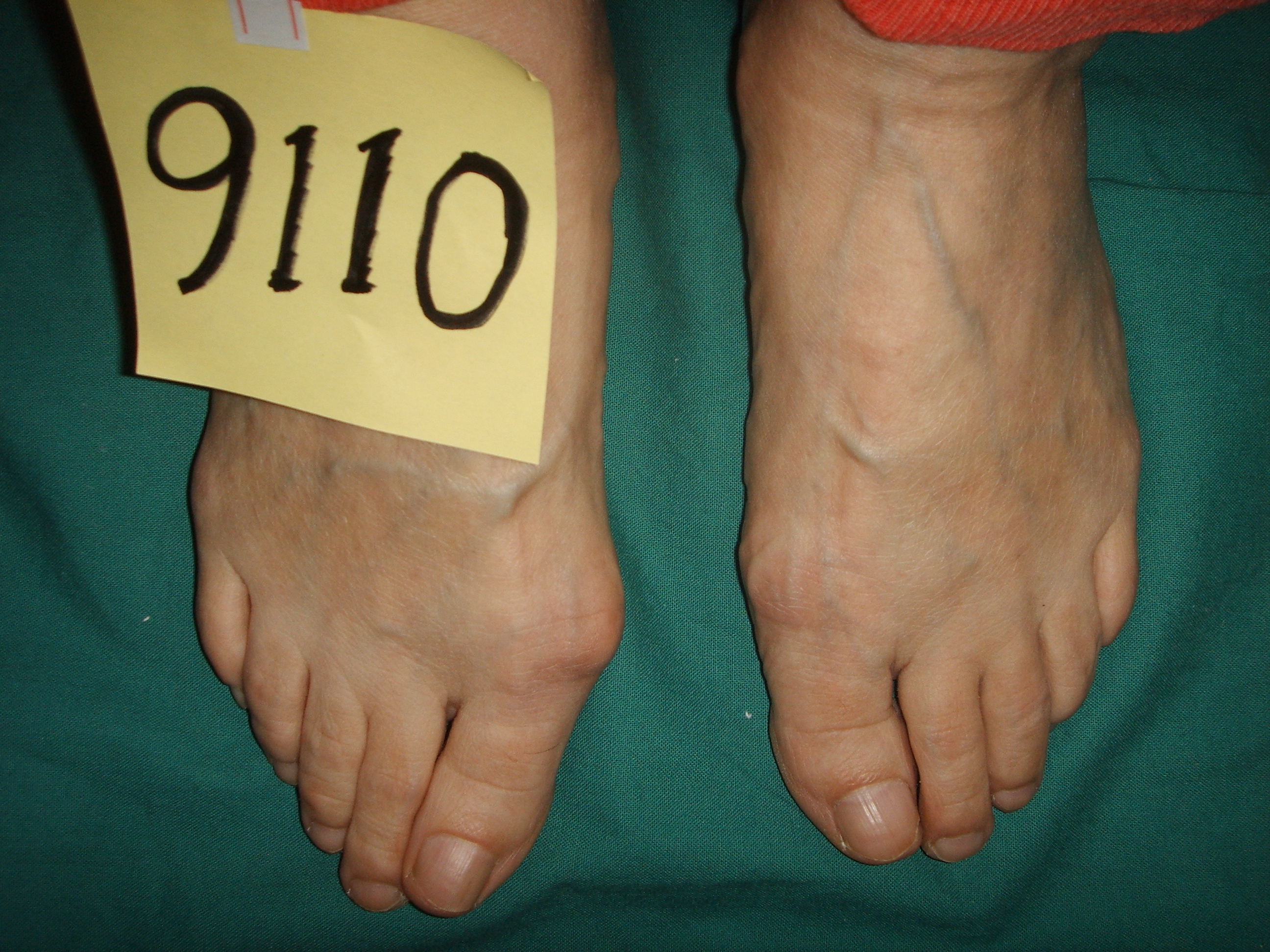 70岁有必要做腰椎手术吗,70岁老人做大脚骨手术可行吗