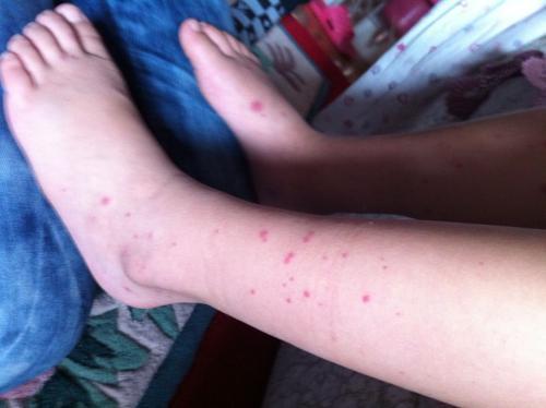 关节型过敏性紫癜可以剧烈运动吗,过敏性紫癜关节疼痛一般多久能好