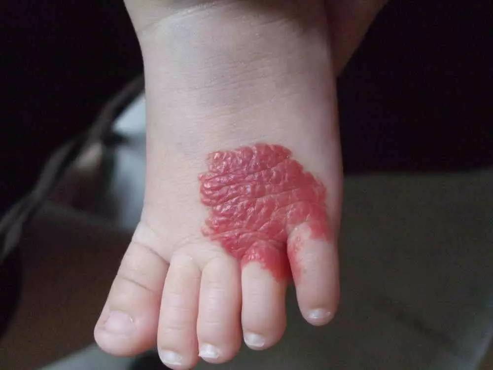 孕期不注意饮食会导致宝宝湿疹吗,孕期不注意饮食孩子会变丑吗